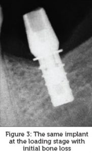 A retrospective survey of an implant, designed to resist bone loss