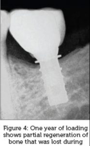 A retrospective survey of an implant, designed to resist bone loss